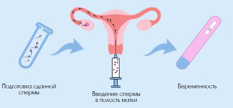 Искусственная инсеминация