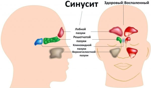 Синусит