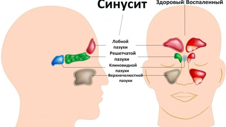 Синусит